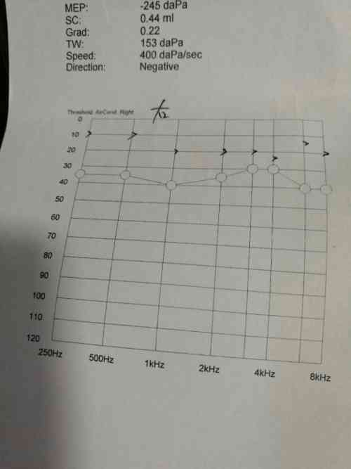 听力检测报告单怎么看数值AC与BC，例如AC47.5.BC43.8