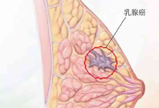 乳腺检查升级：医生借助AI驱动的钼靶技术精准诊断乳腺癌病理报告