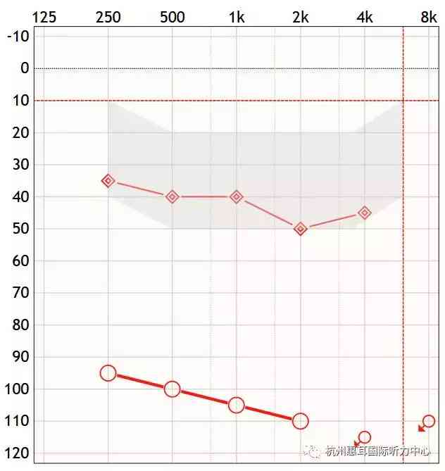 深入解析：纯音测听报告全方位解读与听力损失评估指南