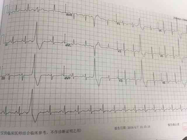 心电报告怎么看：正常指标、心肌缺血与心律不齐解析