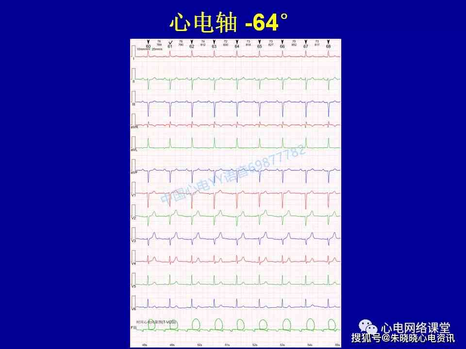 医生教你如何看懂心电报告单：心电检查报告与心电图解析指南