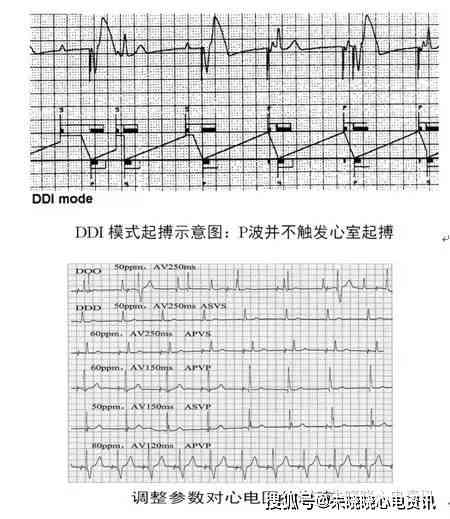 医生教你如何看懂心电报告单：心电检查报告与心电图解析指南