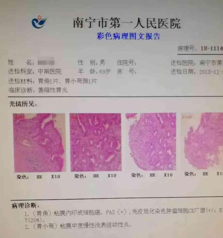 胃镜报告胃癌：如何书写、单写内容、典型提示及与病理不情况