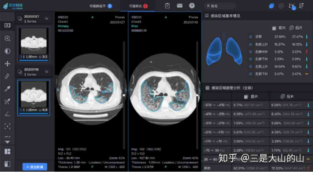 ai看ct报告：在线查询与解读CT报告单及AIS评估