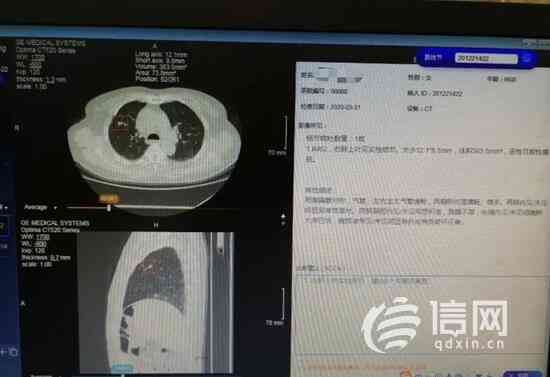 智能胃镜AI辅助诊断报告单