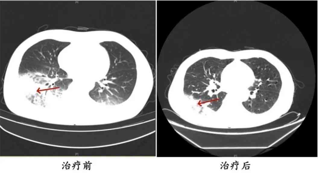 ct报告结合ai医生