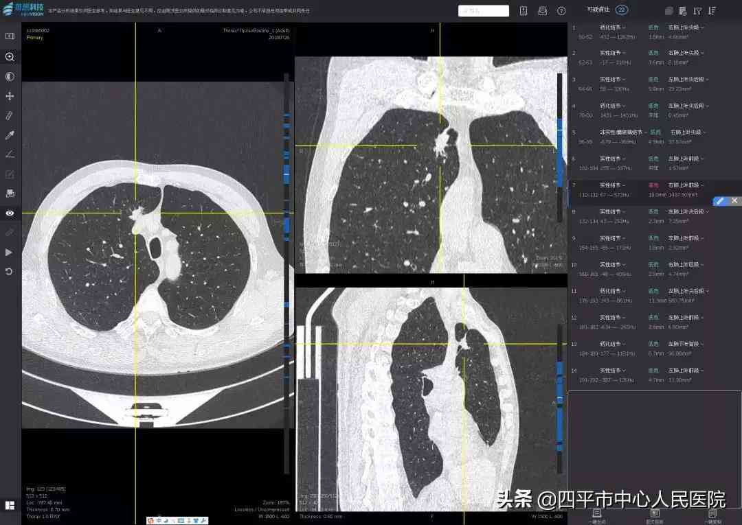 AI健筛查综合报告深度解读与常见疑问解答PDF全文