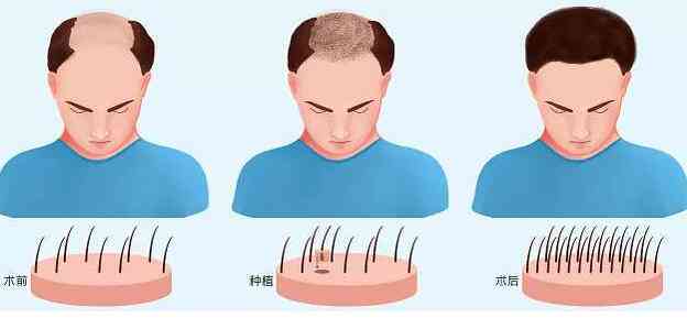 全方位解析脱发问题：从原因到解决方案一网打尽