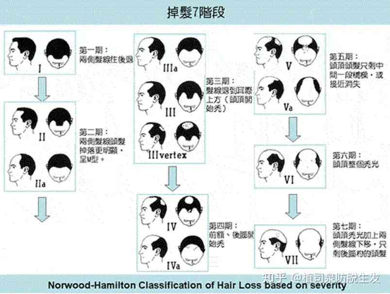 全方位解析脱发问题：从原因到解决方案一网打尽