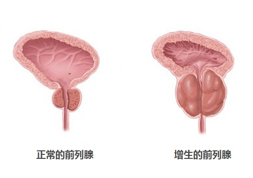 前列腺保健文案ai