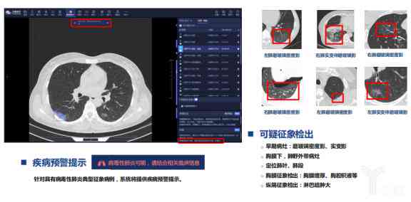 ct报告上ai是im，ais，iac可能性