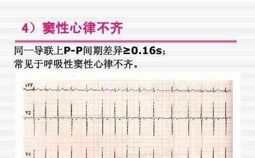 体检报告array：解读含义、出报告时间、性心律说明及三项指标查询方法