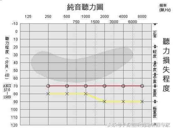 AI辅助解读纯音听力测试报告中的AI阈值含义