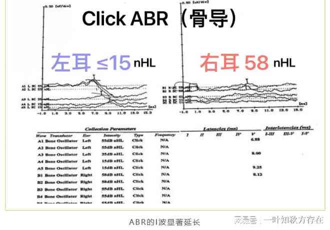 如何全面解读纯音测听报告：深入分析AC（气导）与BC（骨导）结果及意义