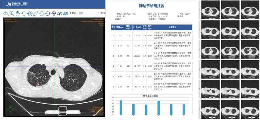 ai智能分析肺微小结节标准报告