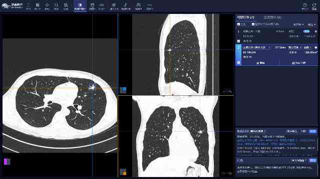 ai智能分析肺微小结节标准报告