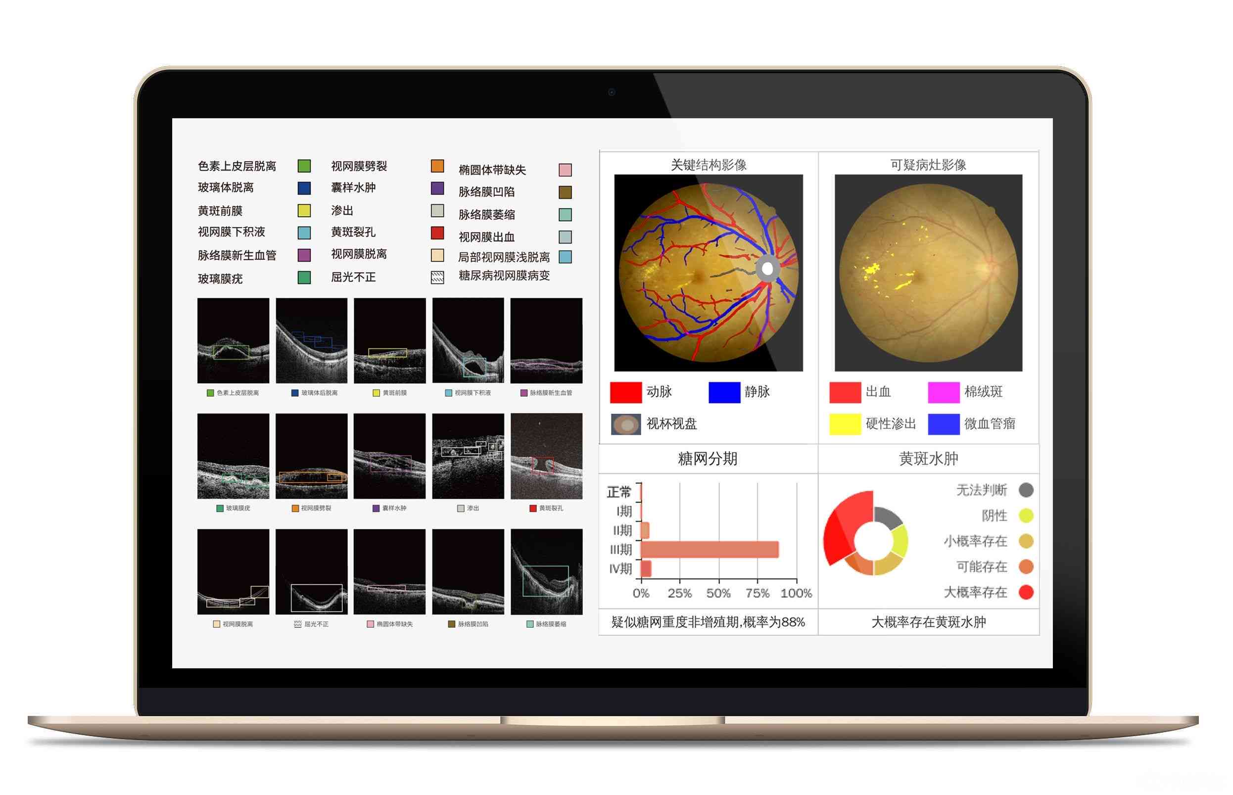 AI眼底镜报告-ai眼底检查弊端