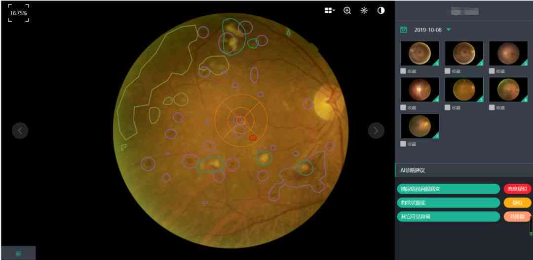 AI眼底镜报告-ai眼底检查弊端
